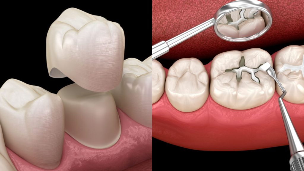 Do You Need a Crown or a Filling? Here’s How to Tell